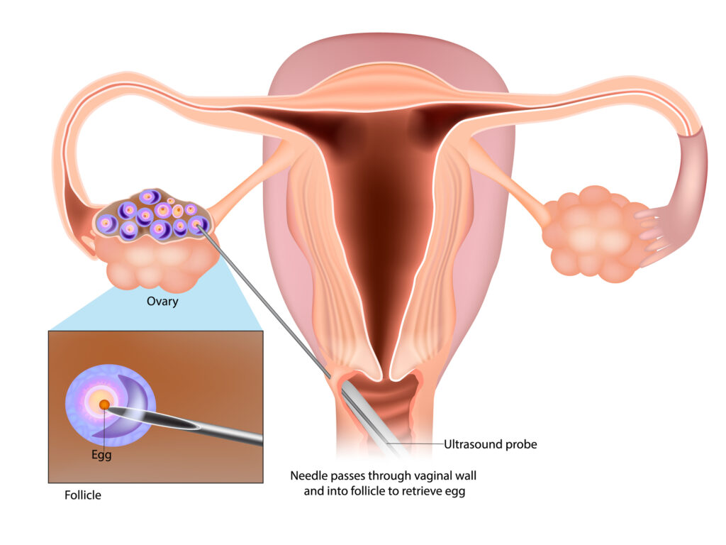 Egg Retrieval Before Endometrioma Surgery